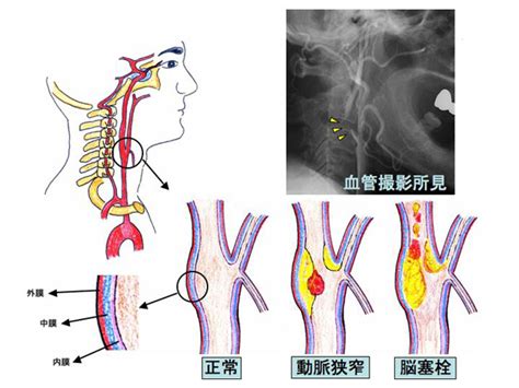 首 脈|頸動脈狭窄｜慶應義塾大学病院 KOMPA